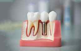 Стоматологические материалы. Имплантация «Топ Рэйт Имплантс»